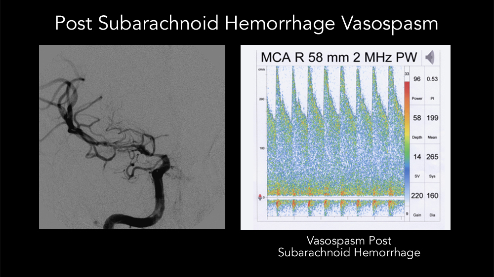 post subarachnoid hemorrhage vasospasm
