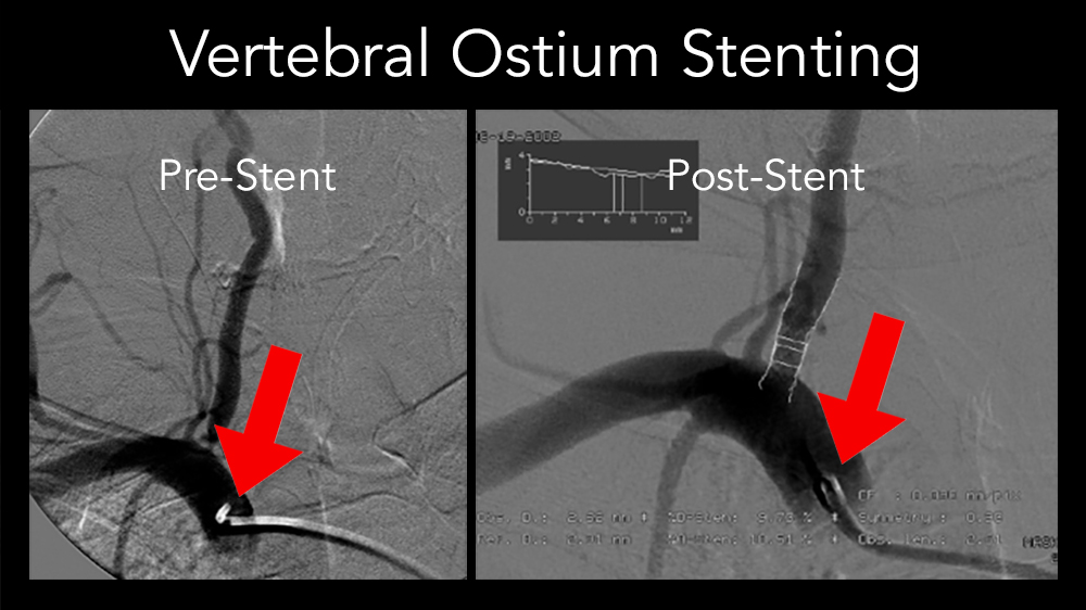 Vertebral Ostium Stenting